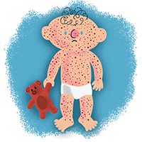 Cartoon of baby with measles