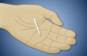 Hand holding hormonal contraceptive implant