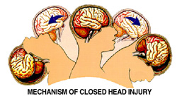 Head injury diagram