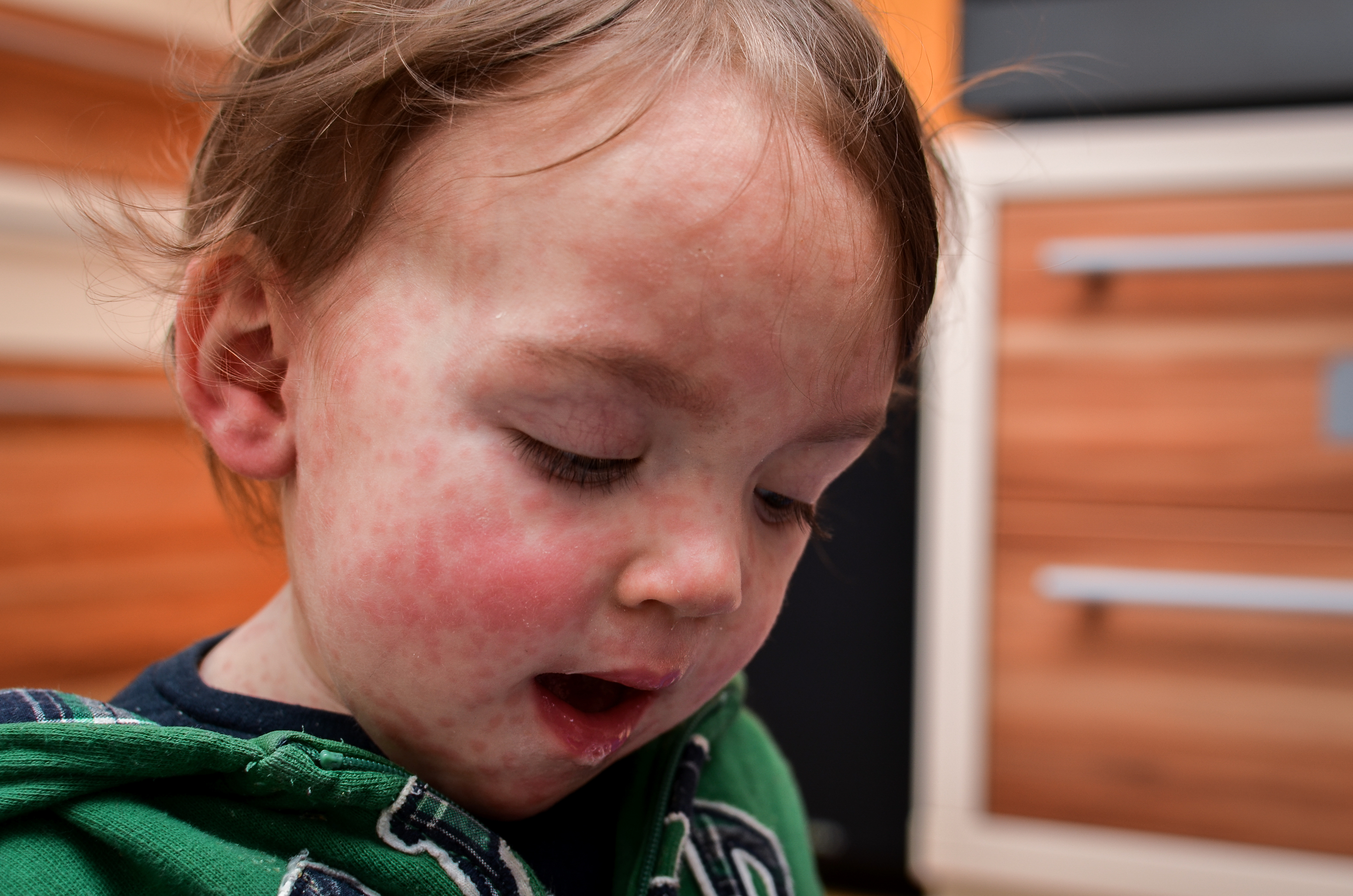 Small child with Measles rash