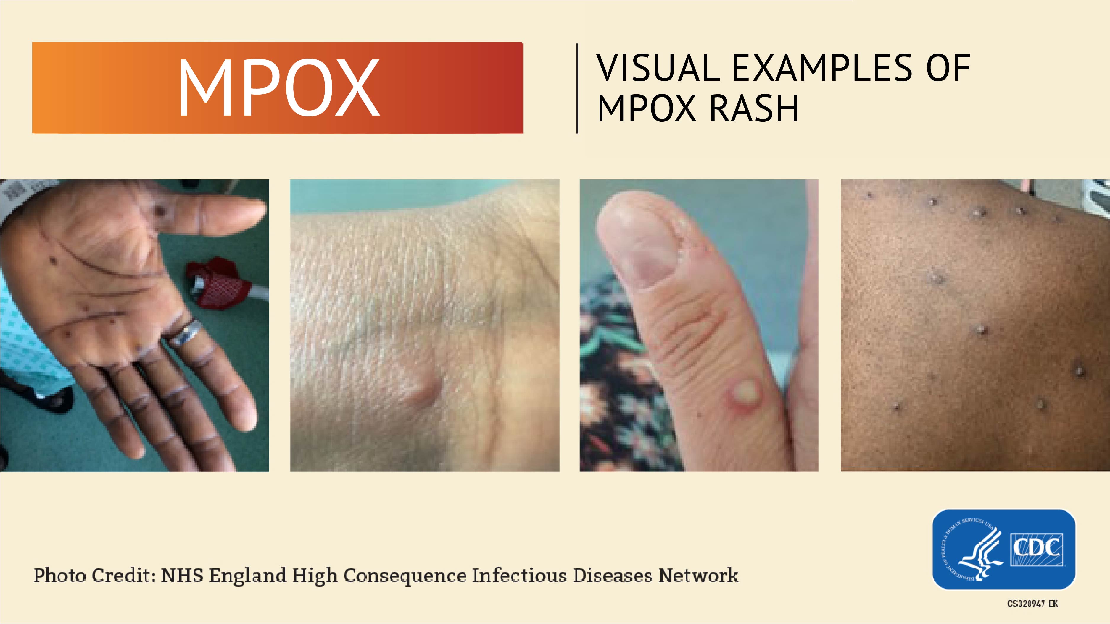 CDC: Visual examples of monkeypox rash. Photo credit: NHS England High Consequence Infectious Disease Network